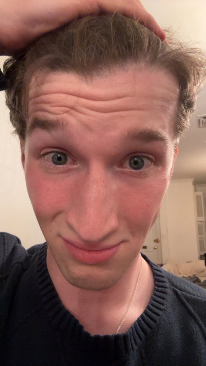 simplifiedseth's tweet image. bells palsy final update (palsy gone)
