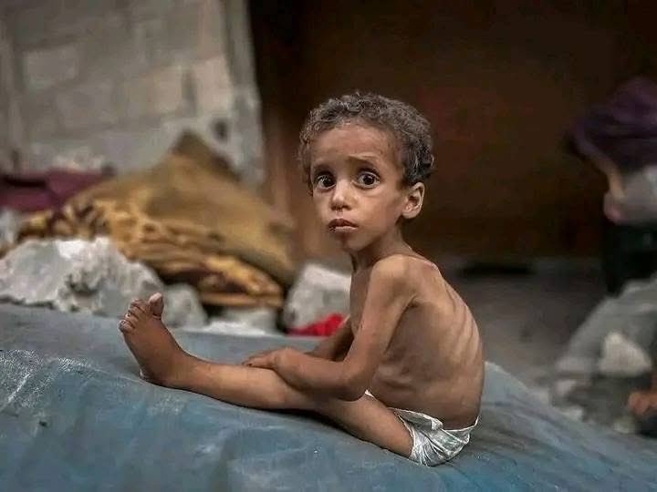 Fatima_Khatun01's tweet image. An innocent Child suffering from malnutrition in Gaza.
My Question is; where is Allah?