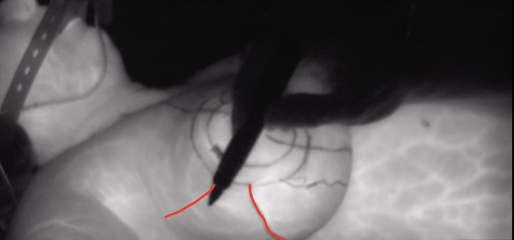 aecirujanos (@aecirujanos) on Twitter photo Nuevo video💻en el #videoatlas: "Valoración colgajos mamarios mediante angiografía intraoperatoria." Nos presentan la técnica de angiografía con ICH para valorar la perfusión en técnicas oncoplásticas mamarias.
👉aecirujanos.es/Valoracion-de-…
<a href="/aec_mama/">aec_Patologíamamaria</a> <a href="/scmi_itec/">aec_cmi</a> <a href="/GVAclinic/">Hospital Clínic de València</a> <a href="/EBuchV/">EBV</a> Nuevo video💻en el #videoatlas: "Valoración colgajos mamarios mediante angiografía intraoperatoria." Nos presentan la técnica de angiografía con ICH para valorar la perfusión en técnicas oncoplásticas mamarias.
👉aecirujanos.es/Valoracion-de-…
<a href="/aec_mama/">aec_Patologíamamaria</a> <a href="/scmi_itec/">aec_cmi</a> <a href="/GVAclinic/">Hospital Clínic de València</a> <a href="/EBuchV/">EBV</a>