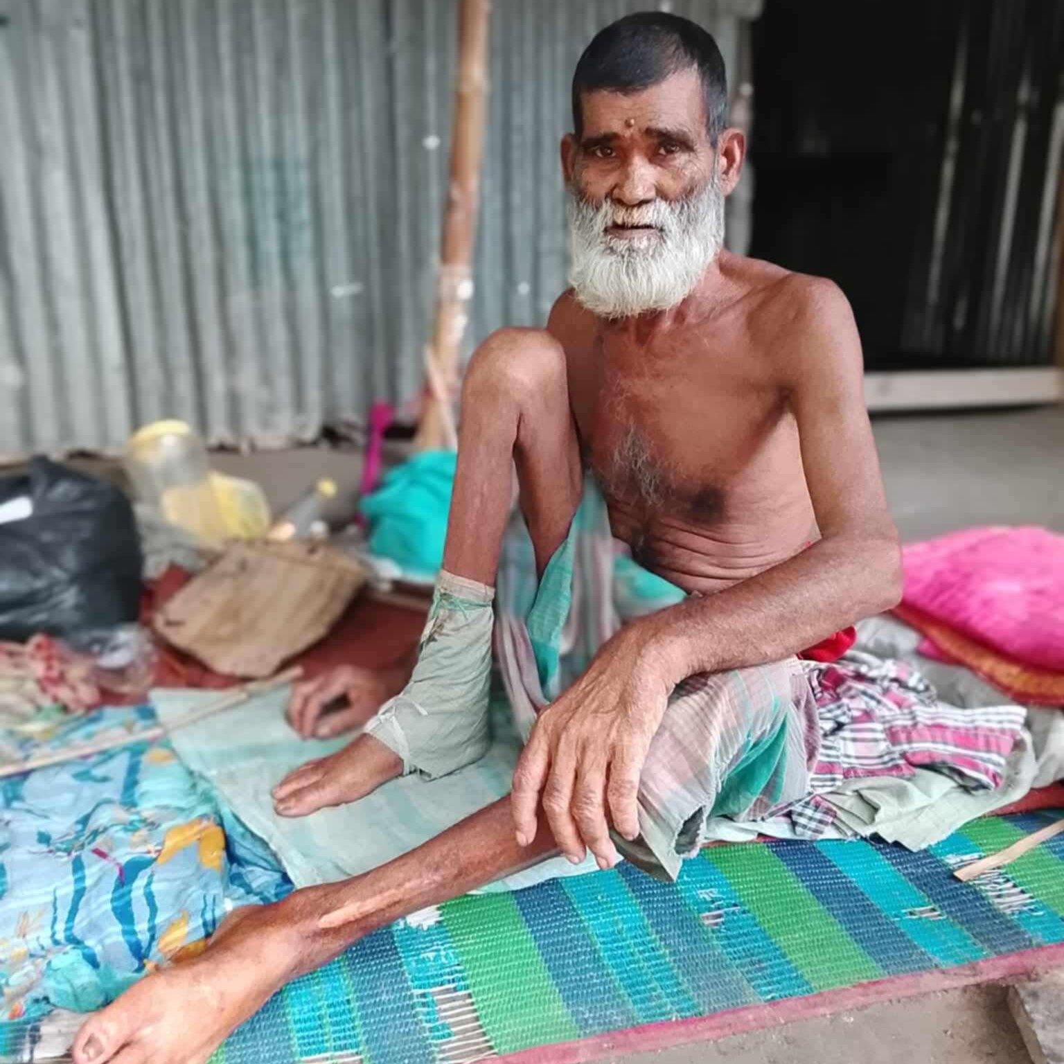 অর্থাভাবে অসহায় বৃদ্ধ সিরু মিয়ার চিকিৎসা থেমে আছে