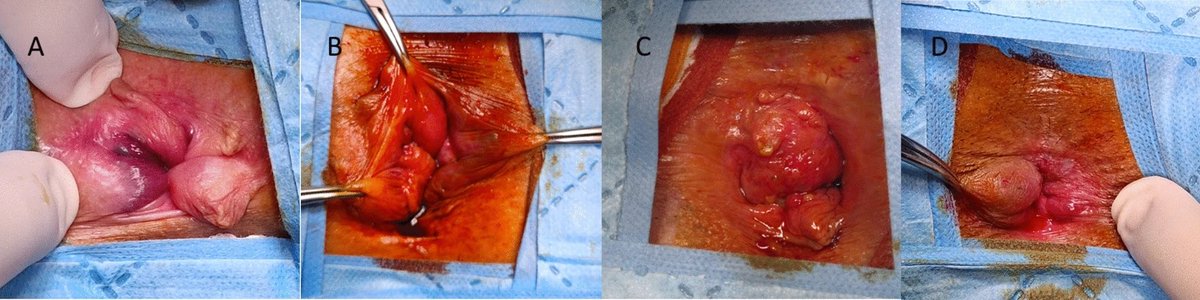 SezaiLeventoglu's tweet image. New Pub: Anatomical distribution of hemorrhoidal piles in advanced disease: clinical insights and correlations
@Gazi_Universite @MemorialSaglik #SoMe4Surgery
@SoMe4Proctology 

link.springer.com/article/10.100…
