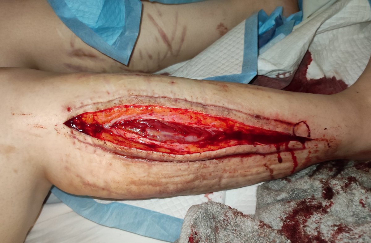 Ellie18277SH's tweet photo. TW  SH

.
.
.
FAKE
.
.
.

the three cuts I did yesterday, I hated the second two could only expose a small amount of muscle on one before I gave up and started cutting where I usually do it on the right leg lmao https://t.co/BzAuEMQk8h