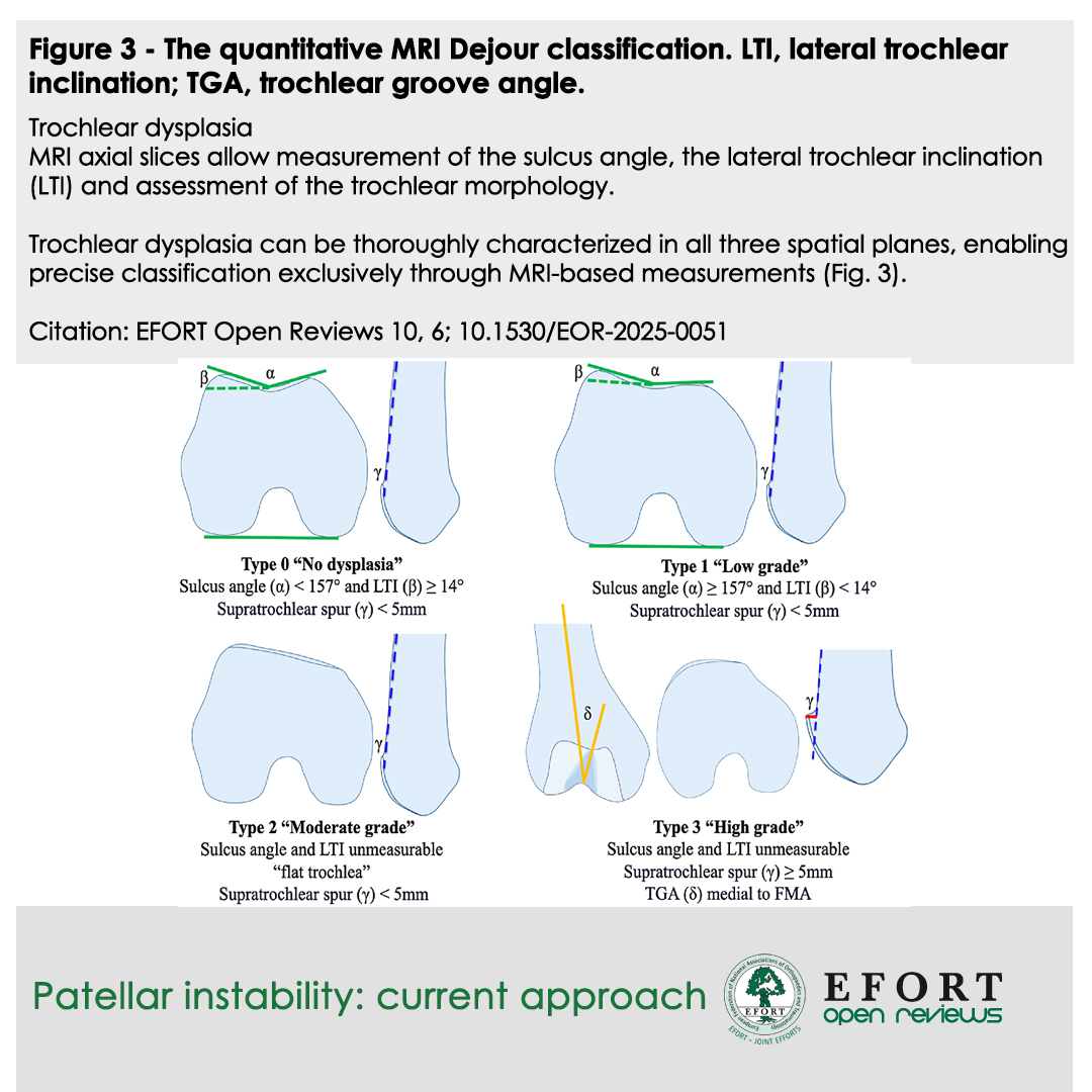 #EOR - Current approach to #PatellarInstability 🦵
Focus on #MRI 🔬 for precise risk factor #TrochlearDysplasia, #PatellaAlta, TT-TG assessment
"Menu à la carte" guides tailored treatment 📝 #MPFL recon, TTO, trochleoplasty 🛠️
🔗 bit.ly/EOR250607
#KneeSurgery #EFORT