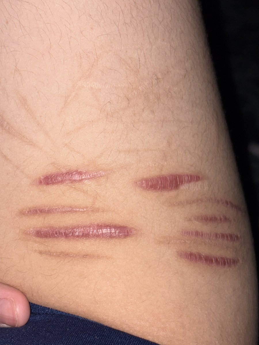 lambonesz's tweet photo. #shtwt

Hey guys update on my leg! It healed good I’m so sad it shrunk after all that pain it put me thru😩 at least give me a cool scar 😒 anyway yay! https://t.co/y9wJQiTHye