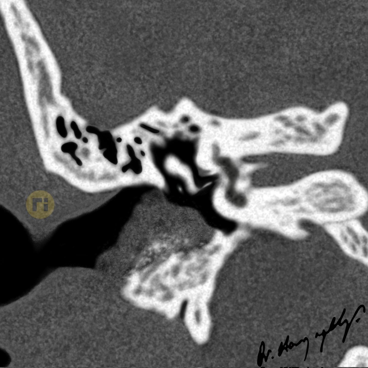 drharunyildiz's tweet image. EAC Cholesteatoma
pixel by pixel handmade!
#radiologicalillustration ✍️