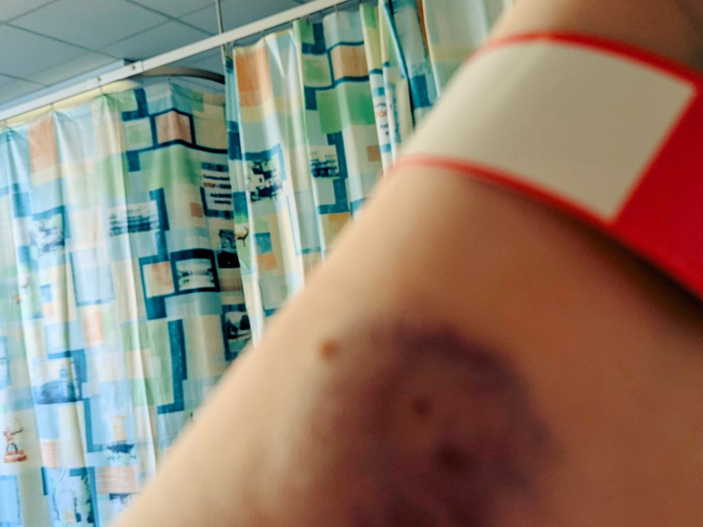 BradfemlyWalsh's tweet image. Who wants to see something gross? Yes, check out those fucking awful hospital curtains. No-one should have to suffer this.
Also they really fucked up my arms trying to get a cannula in last night and it's still not been used, FML.