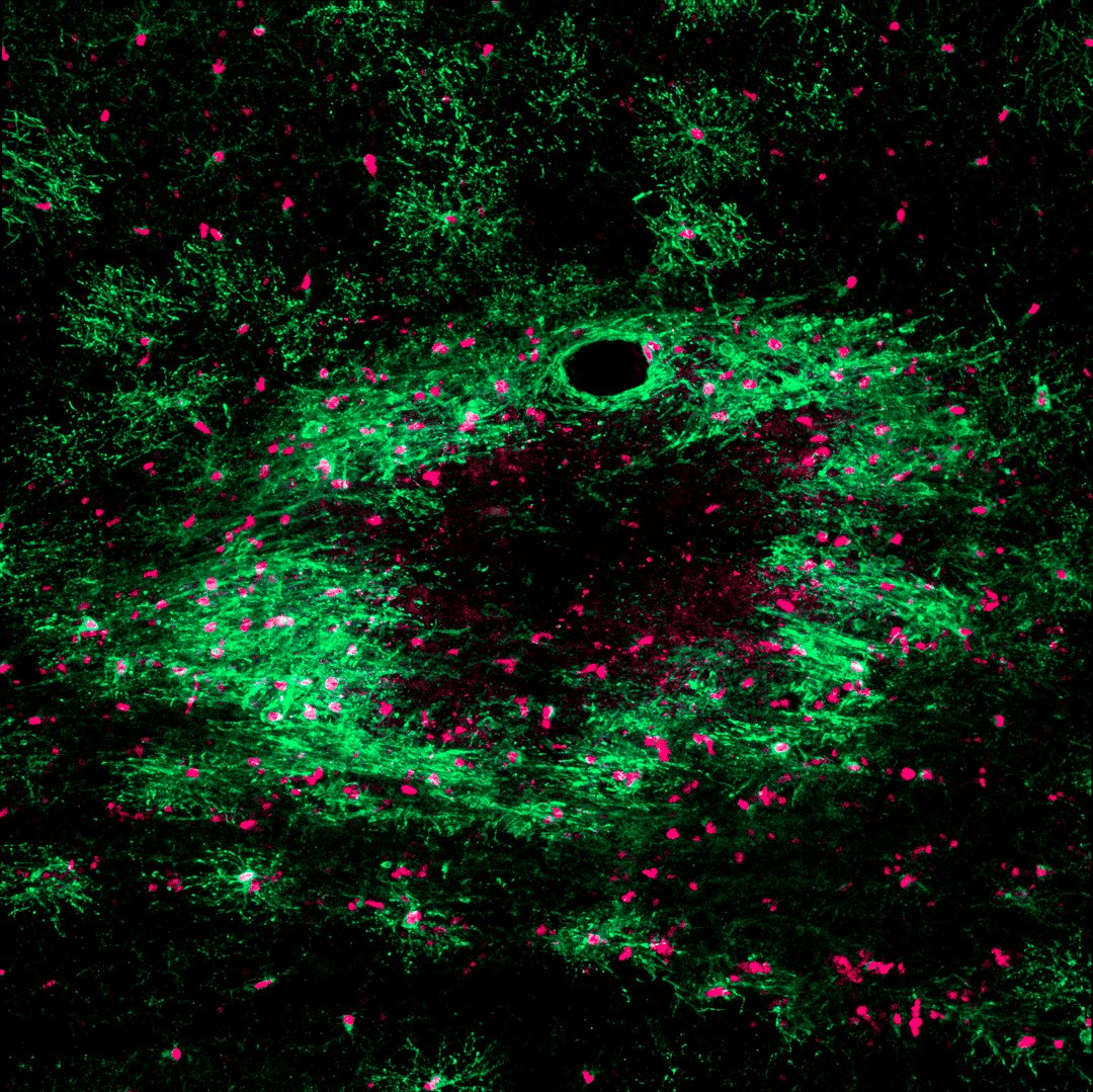 NeuroAlc's tweet image. #SciencePhoto_IN
"Light Scars: The Invisible Art of Remyelination"
Author: Dr. Alice Staffa
Lab: @IPO_lab
"After a demyelinating injury, the brain activates oligodendroglial cells (magenta) to proliferate and differentiate (emerald) to initiate repair. With a @LeicaMicro SPEII."
