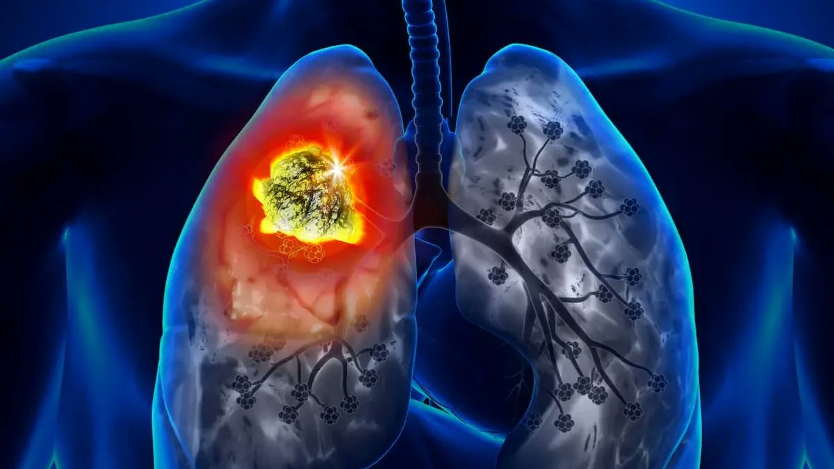 oncodaily's tweet image. Registration is Open for Spanish: Targeted Therapies in Lung Cancer Patient Forum - Luis E Raez
@LuisRaezMD
oncodaily.com/blog/luis-raez…
#OncoDaily #Oncology #Cancer #Health #Medicine #MedTwitter #MedEd #MedOnc #MedNews #TargetedTherapy