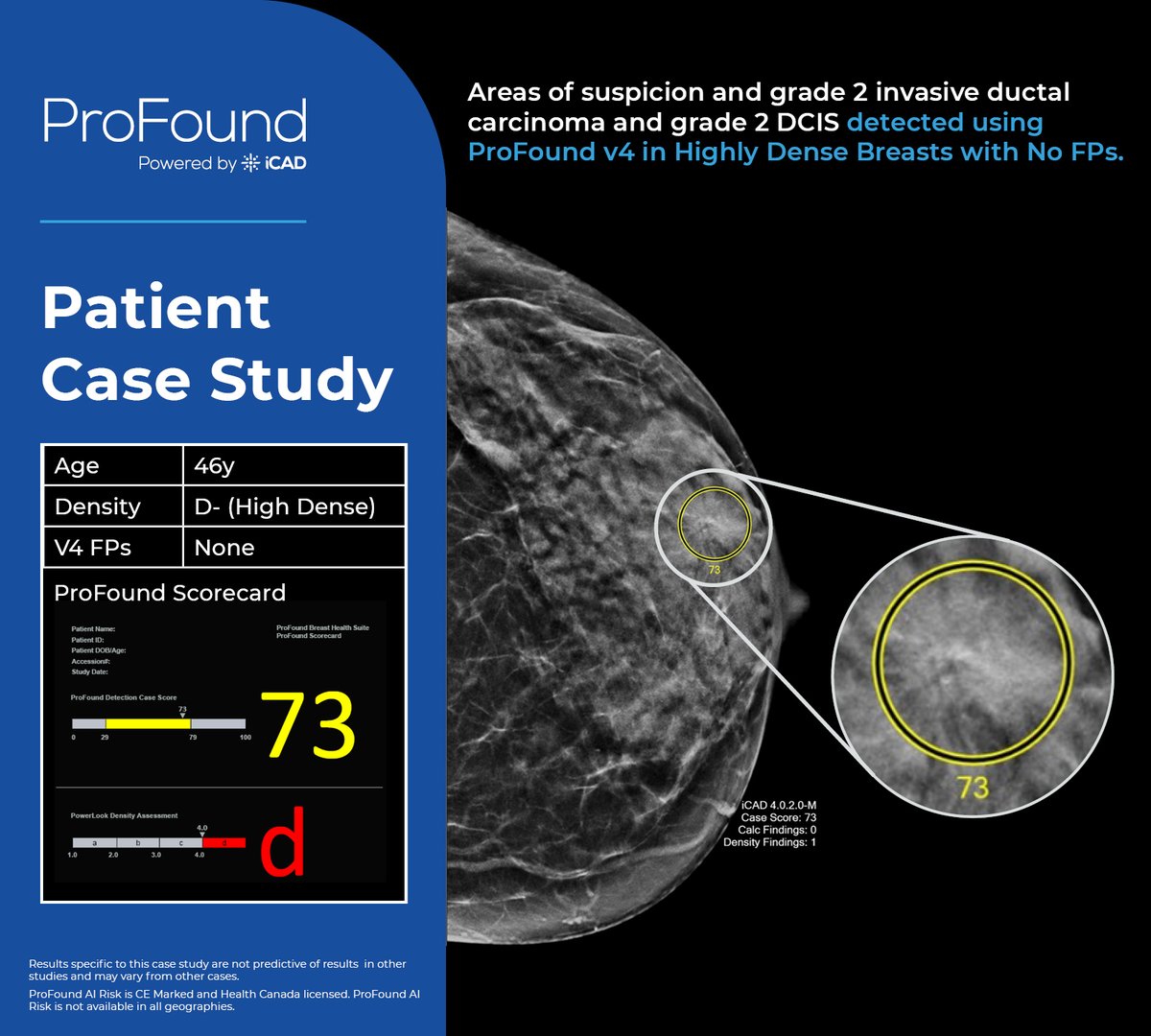 [#PatientCaseStudy] Areas of suspicion and grade 2 invasive ductal carcinoma and grade 2 DCIS detected using ProFound Detection v4 in Highly Dense Breasts with no false positives.

✨ What tools are you using to help find breast cancer faster and earlier?

bit.ly/3IAwosc