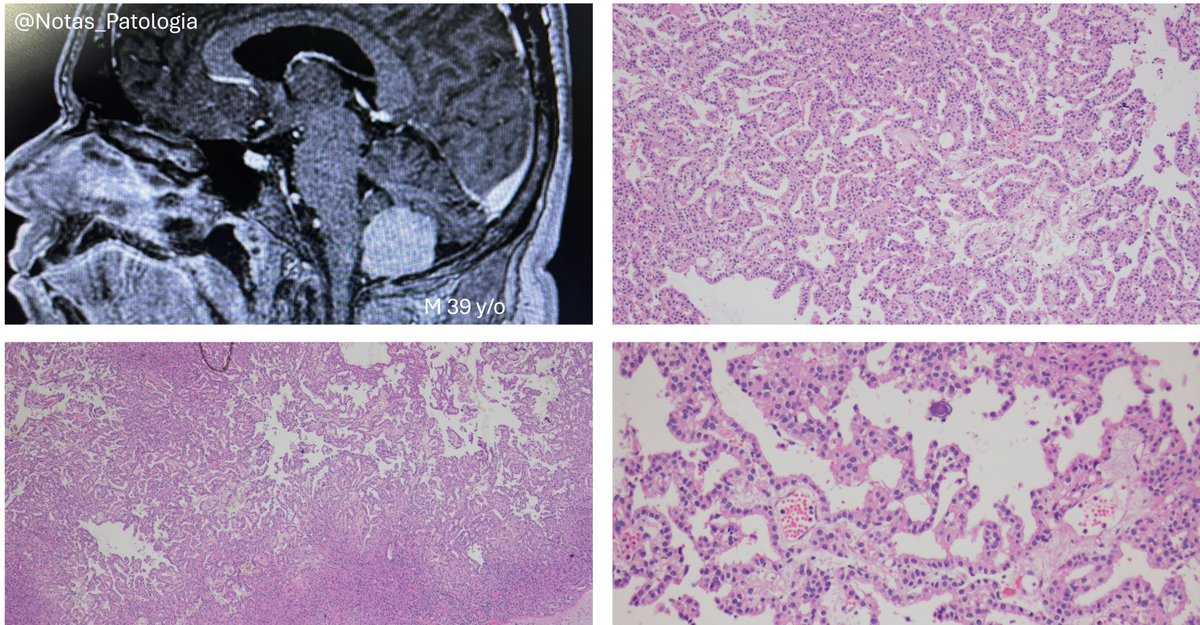 🧠 Choroid Plexus Papilloma (CPP)
📌 A benign neoplasm that can still have significant clinical impact

Choroid plexus papilloma is a rare tumor of the central nervous system, classified as WHO CNS5 Grade 1 (2021) due to its indolent behavior. It arises from the choroid plexus