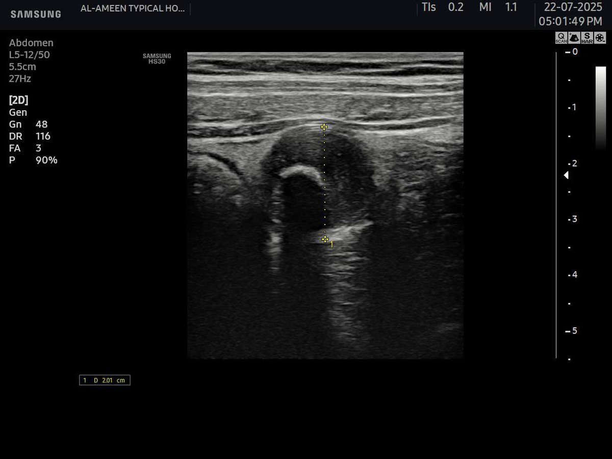 EchoTech_4's tweet image. See these clips and put your opinion!

A 13 years male presented with acute RIF pain.

WBC 12000
Neutrophils 86

#EchoTech  #POCUS #Ultr