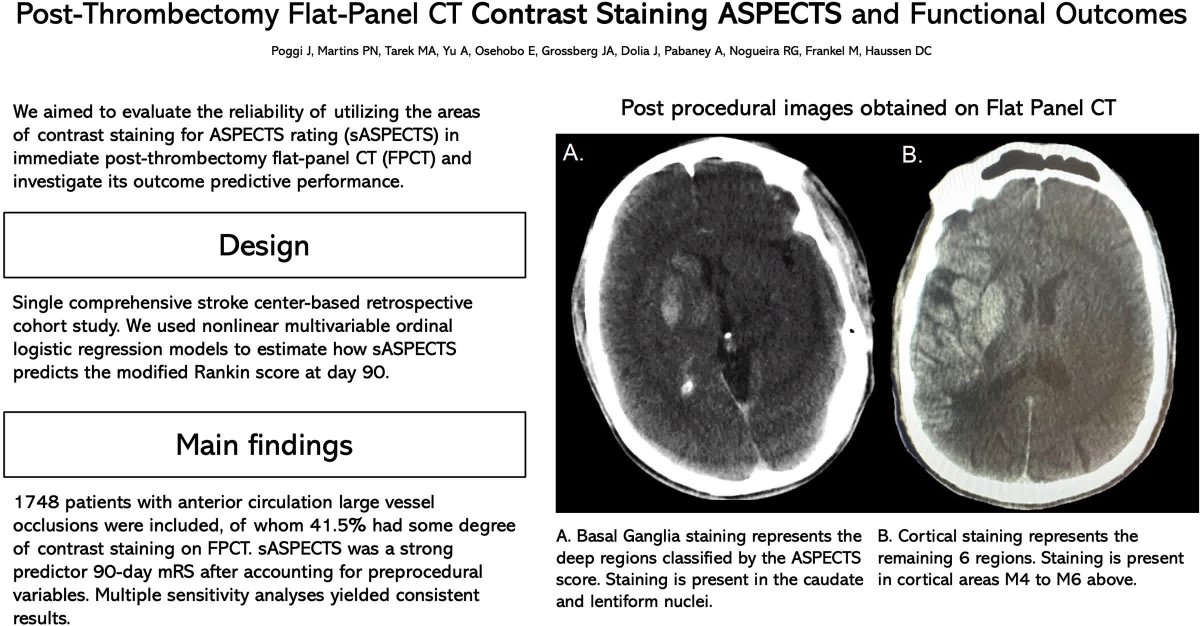 #STROKE: In an institutional EVT database, contrast staining for ASPECTS rating (s-ASPECTS) — an imaging metric derived immediately after EVT — was a stronger predictor of functional outcomes than standard ASPECTS. #AHAJournals ahajrnls.org/4lHOrLv