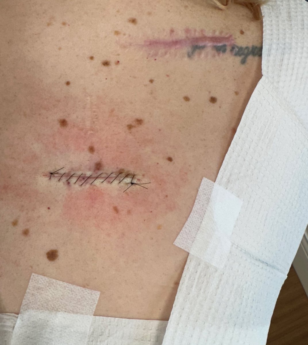 MrsKtotheYost's tweet image. Go to the dermatologist.
Wear sunscreen, sun protection
🫶🏻 a melanoma girl 😒😬 #isurvived #clearthelist #ihateithere 😂
