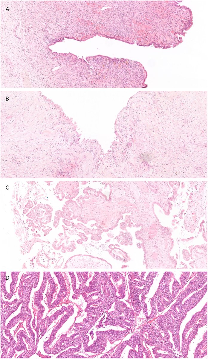 Human_Pathology's tweet image. New in #HumPathol: The occurrence and histopathological recognition of atypical endometriosis in patients with ovarian endometriosis – a retrospective cohort study. sciencedirect.com/science/articl… #pathology #PathTwitter #PathX #gynpath