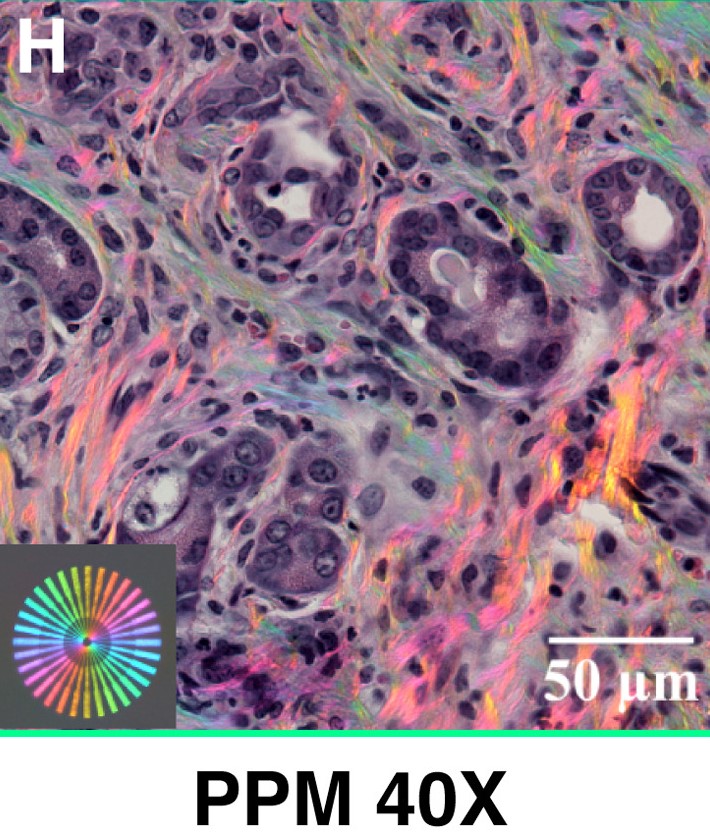 AJPathology's tweet photo. Computationally enabled polychromatic polarized imaging enables mapping of matrix architectures that promote pancreatic ductal adenocarcinoma dissemination.  

Full text: https://t.co/PP2R6RX5vI https://t.co/UB5FcxIQCm