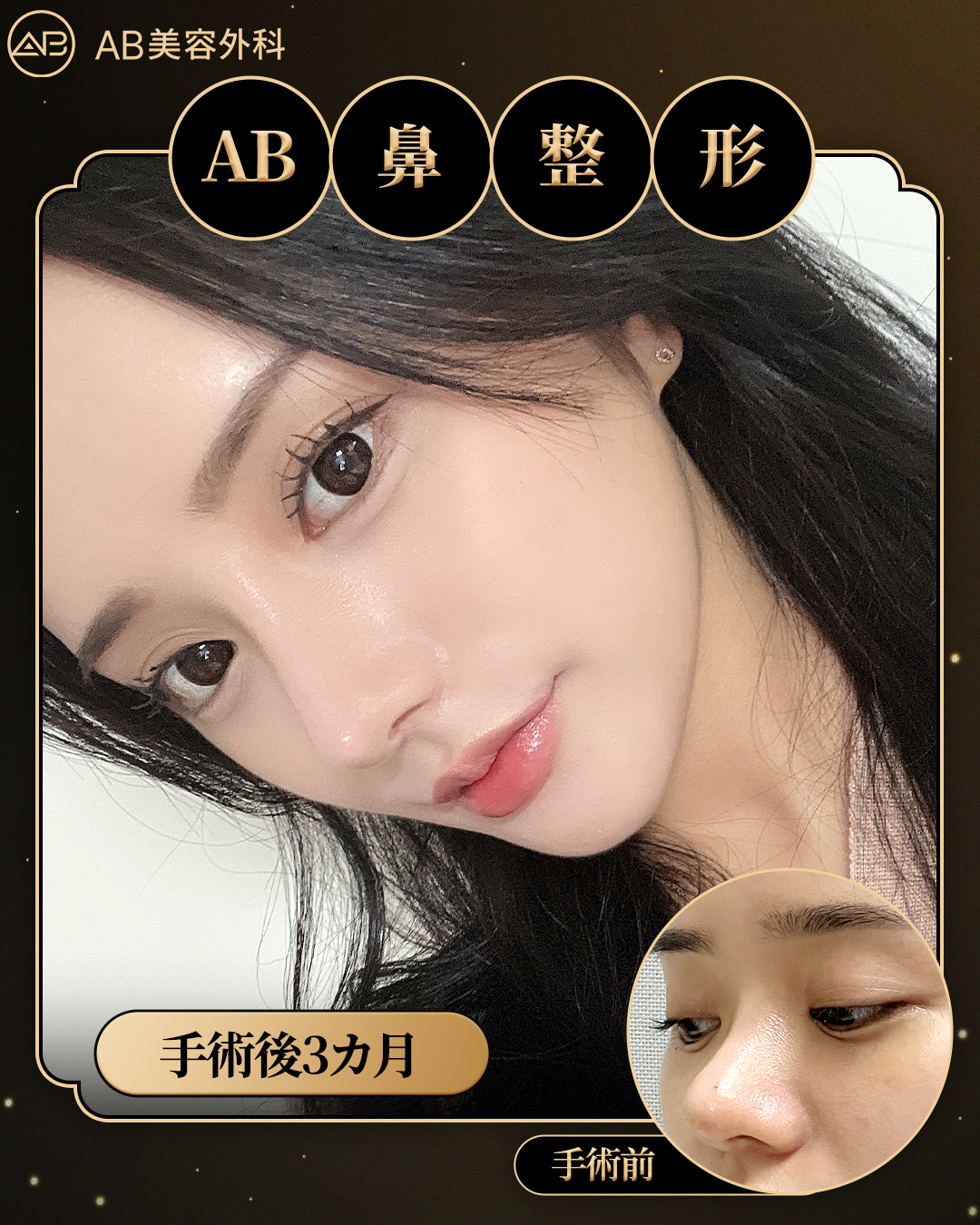 公式】韓国AB美容整形外科🌺AB PLASTIC SURGERY on X: 