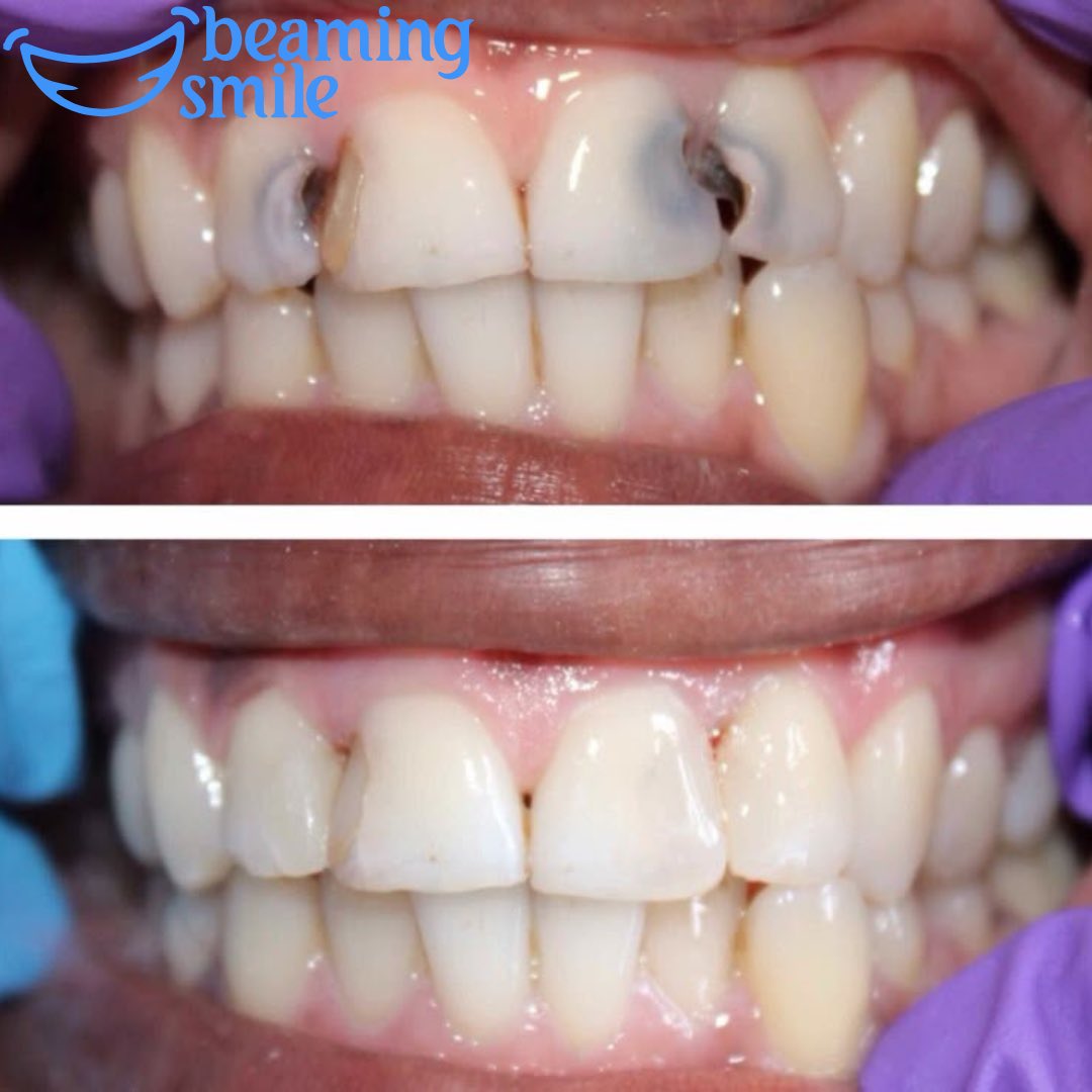 mybeamingsmile's tweet photo. Itโs time to take care of your teeth. Dm or call us on 0558880629 for your dental treatments.
#beamingsmile|#HearOurPleaMOH|#FairPayMOH|Kofi Adams|#wafcon2025|Black Queens https://t.co/Ip4s1fIorG