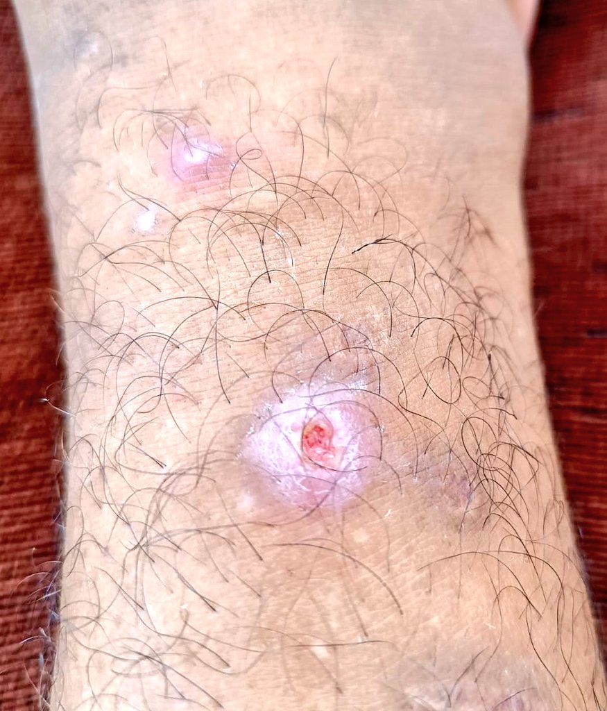khaldonhd123's tweet image. 💔 From the heart of devastated Gaza… I cry out: Save me.
🔗 Safe donation link:
👉 chuffed.org/project/137369…
I’m a young Palestinian man, injured in my leg 🦶, unable to work, and responsible for a family of 11 👨👩👧👦.
Every day, we struggle just to find a bite to eat 🍞🥺…
We…