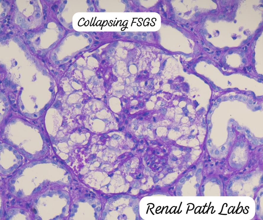 RenalPathLabs's tweet image. This FSGS was scarier than any crescent…fierce looking, activated podocytes as if ready to engulf the tuft..
And look at the tuft-scared to the core..
🥹😱
#CollapsingFsgs #RenalPath #PathTwitter #Nephtwitter #RenalPathSociety #AskRenal #RenalPathLabsGurugram #KidneyBiopsy