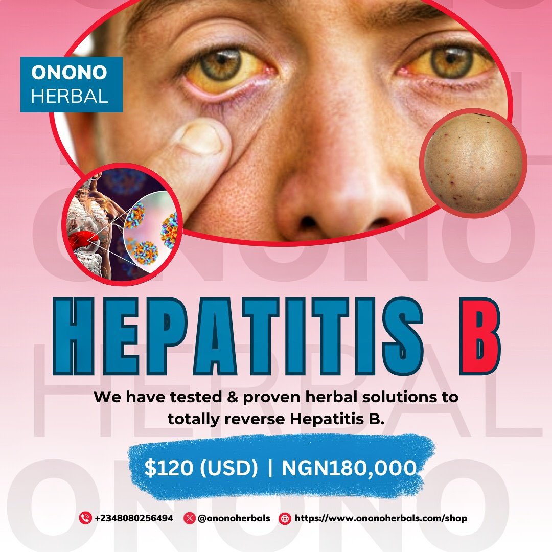 ononoherbals's tweet image. 🦠 HEPATITIS B Total Herbal REVERSAL
(Get rid of it permanently, not just viral load reduction)!
🚨 PRICE
$120 USD
₦180,000
🌍 WORLDWIDE DELIVERY 🚚
Send a DM To Order or Message me on WhatsApp directly with this link or save the number on my bio 👇…