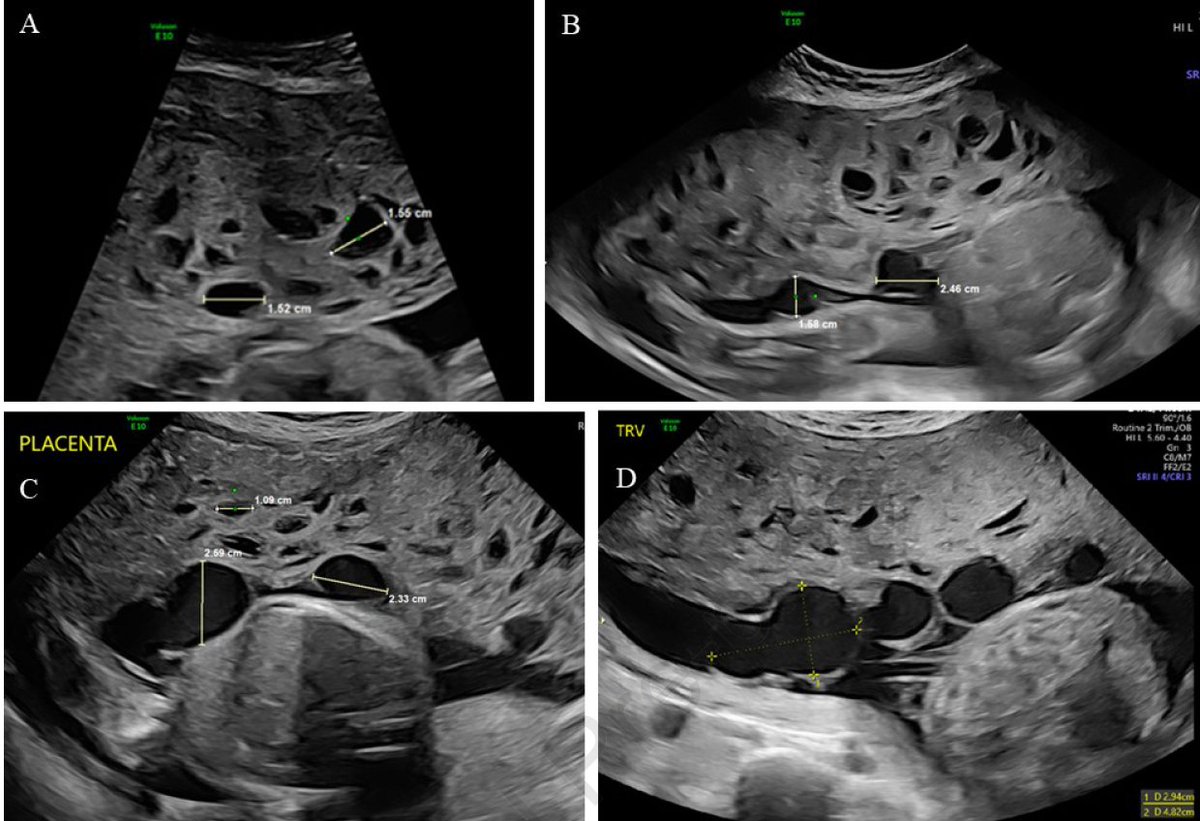 Zebras in a Snowstorm: Ultrasound guidance for differentiating placental mesenchymal dysplasia from hydatidiform mole. Serial imaging from the second and third trimesters ow.ly/1zoi50SMgma @ACOG <a href="/ISUOG/">ISUOG</a> @AIUM  #MedicalImaging #ObstetricUltrasound