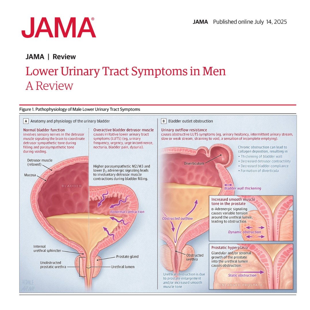 JAMA_current's tweet image. Lower urinary tract symptoms are common among men and are usually caused by BPH, overactive bladder detrusor, or both.
This Narrative Review summarizes current evidence on the epidemiology, pathophysiology, diagnosis, and management of lower urinary tract symptoms in men.…