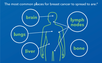 ABCGlobalAll's tweet image. #DYK where breast cancer is most likely to spread?
🔗abcglobalalliance.org/abc-info#abc-i…
#BreastCancerAwareness #MBC #ABC #BreastCancer