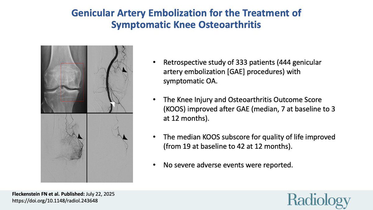 DrGluRu's tweet image. Largest published cohort study to date on Genicular Artery Embolization #GAE for knee pain from osteoarthritis #irad Great work by our European colleagues.
pubs.rsna.org/doi/10.1148/ra… @SIRRFS
