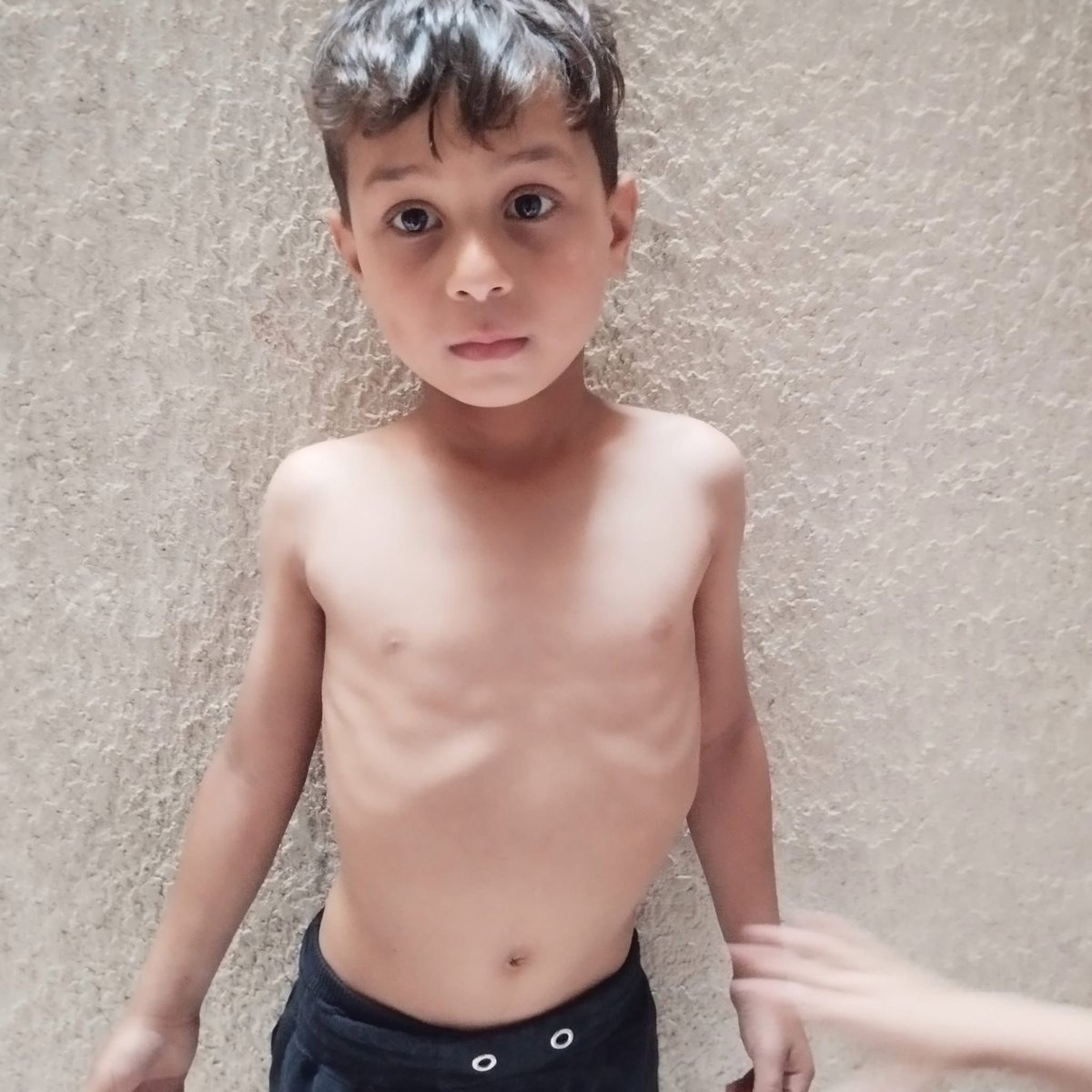 Rushdibbc's tweet image. This is my nephew in Gaza.
He hasn’t had a proper meal in days, only a small portion of lentil soup .
His small body is a witness to a massive deliberate man made starvation.