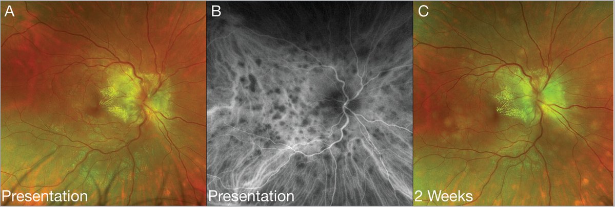 Figure 1. Utility of indocyanine green angiography (ICGA). (A) Examination of the right eye of a patient with sarcoid uveitis showed very few hypopigmented choroidal lesions. 

Read more: tinyurl.com/yk8m6965

#ophthalmology #retina