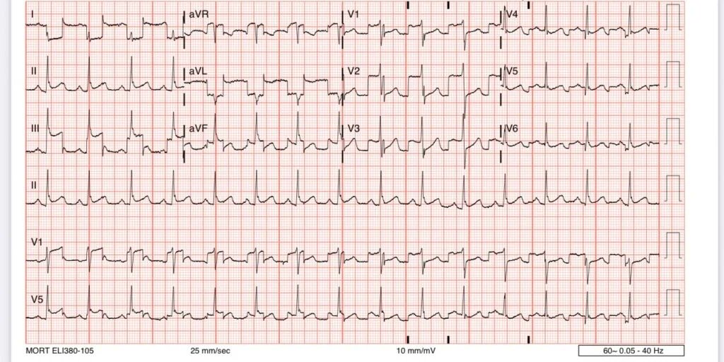 smithECGBlog's tweet image. Acute chest pain. Activate the cath lab?
drsmithsecgblog.com/acute-chest-pa…
@PendellM