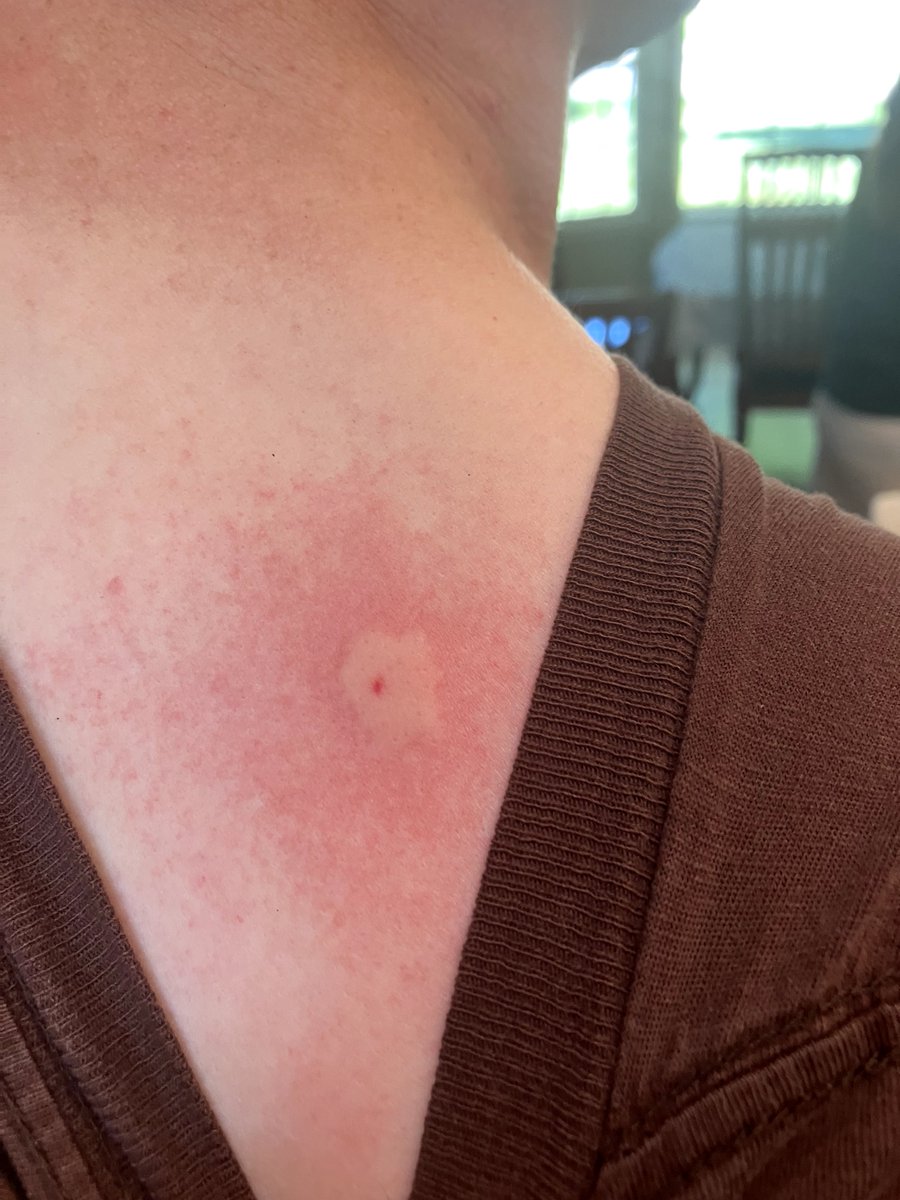 david_shane's tweet image. Out for a pleasant bike ride, and some critter nabs me either through or under my shirt. Tsk tsk.
