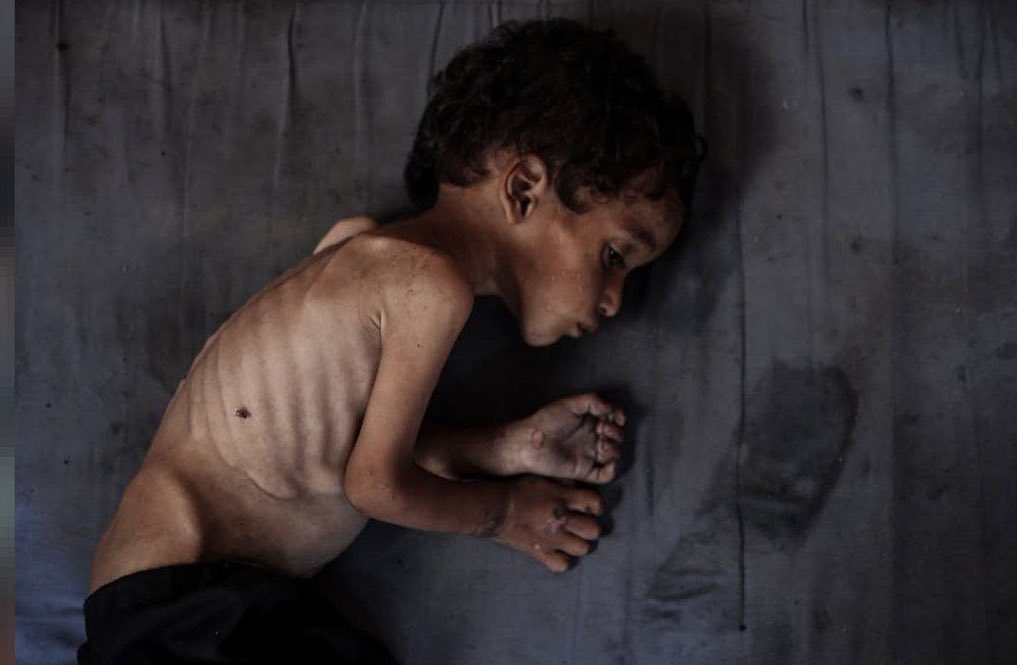 asma196873's tweet image. Our children are dying silently, their insides eroding from the cruelty of famine and their innocence. These are not numbers, but human beings with their lost names and laughter. We demand the opening of the crossings as an urgent humanitarian duty to save what remains of life.💔
