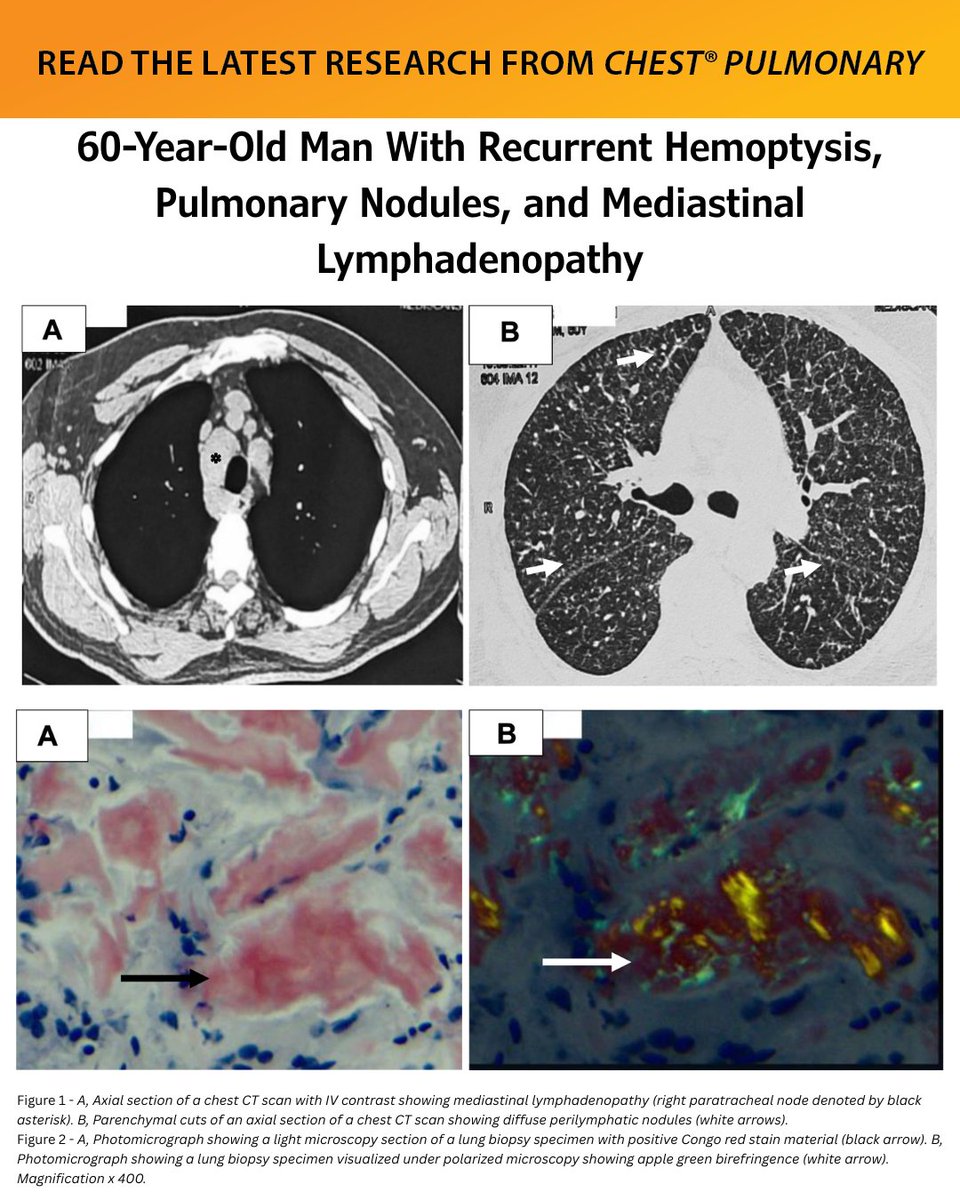 journal_CHEST's tweet image. 60-Year-Old Man With Recurrent #Hemoptysis, #PulmonaryNodules, and Mediastinal #Lymphadenopathy
What's the diagnosis? Read more in the June issue of #journal_CHESTPulm: hubs.la/Q03y81M40
#MedEd #JournalCHEST