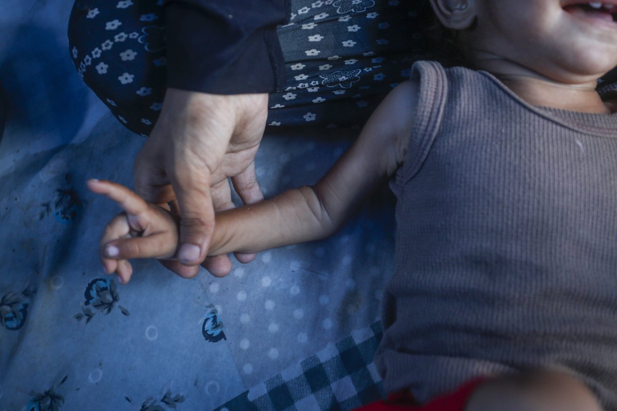 UNRWAes's tweet image. Los análisis de desnutrición realizados por nuestros equipos muestran que la desnutrición aguda en menores de cinco años se ha más que duplicado entre marzo y junio. Uno de cada diez niños examinados en nuestros centros de salud presenta desnutrición.