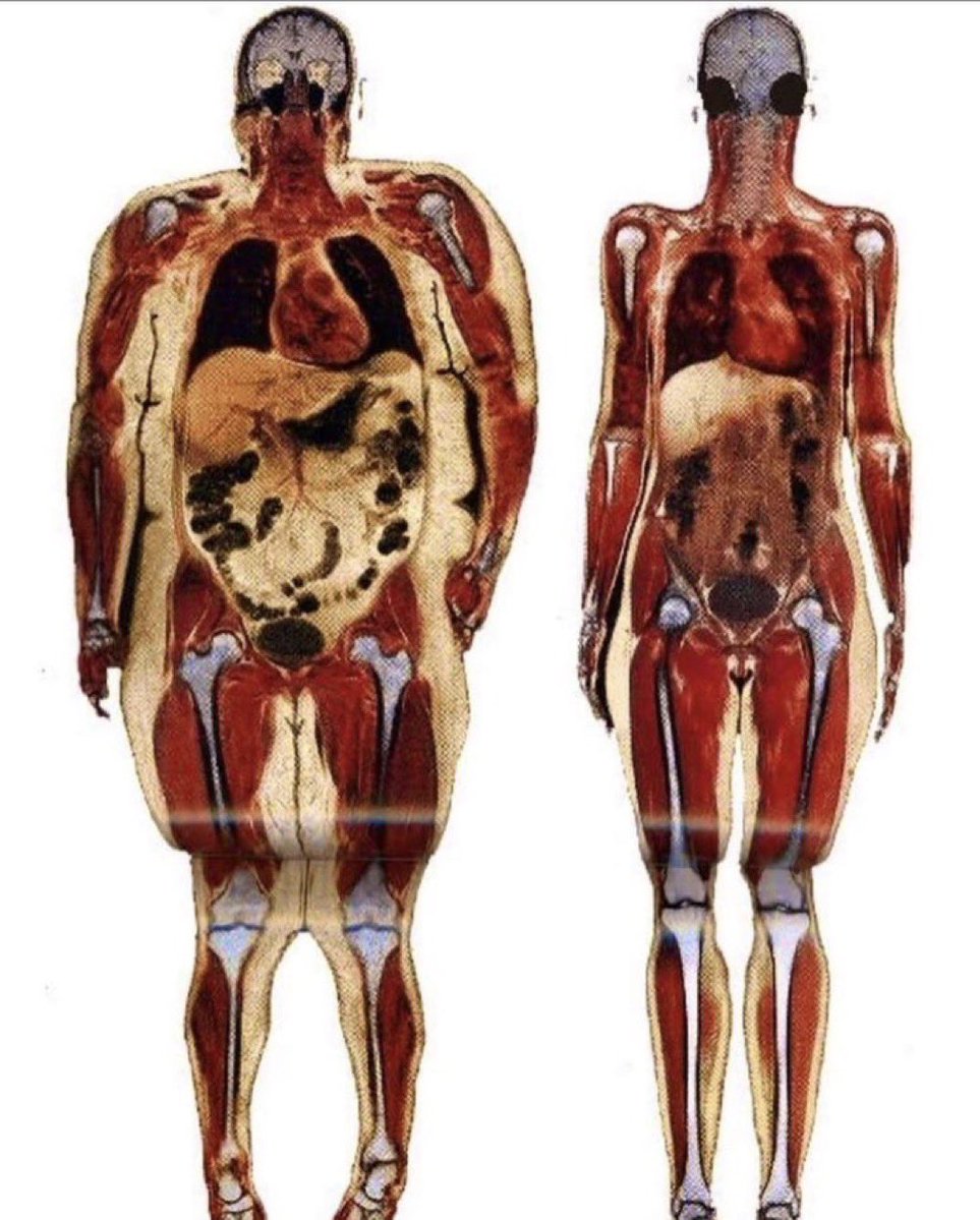Paul_Wischmeyer's tweet image. Extraordinary scans that reveal what obesity does to a human
#MedEd #FOAMed #obesity #nutrition #dietitian #TipsForNewDocs #Medical #Medstudents #NutritionMatters #Health