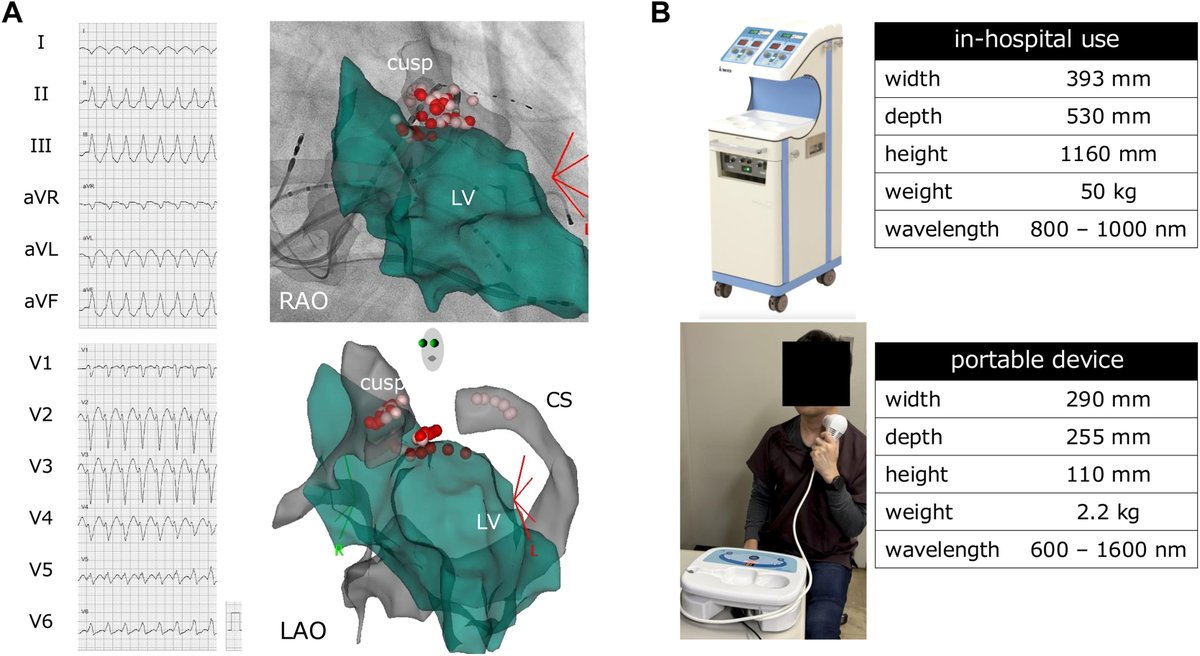 🌟 #CoolCaseOfTheMonth: A new study presents a case of a nonischemic cardiomyopathy patient with drug-refractory ventricular arrhythmia showing frequency-dependent suppression and sustained management for >1 year using a portable stellate ganglion phototherapy device ⬇️