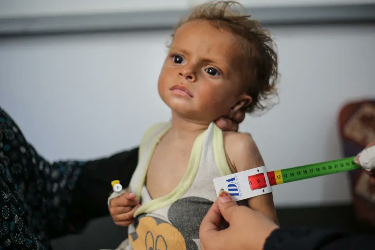 ClaudaTanios's tweet image. A malnourished Palestinian child is examined at Gaza's al-Awda Hospital.
📸 @AFPphoto
