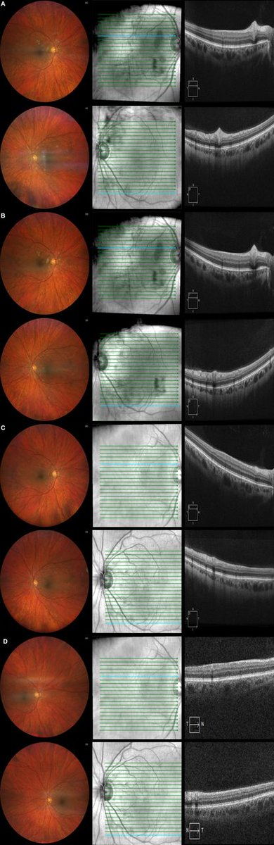 🚨 New Case Report Published 🚨
Asymptomatic bilateral retinitis in Q fever endocarditis – a rare ocular manifestation of a zoonotic infection.
📍Rural Aus
🔬 Multisystem 
🧠 Eye as dx window
🔗 casereports.bmj.com/content/18/7/e…
#Ophthalmology #IDtwitter #Zoonosis #QFever #BMJCaseReports