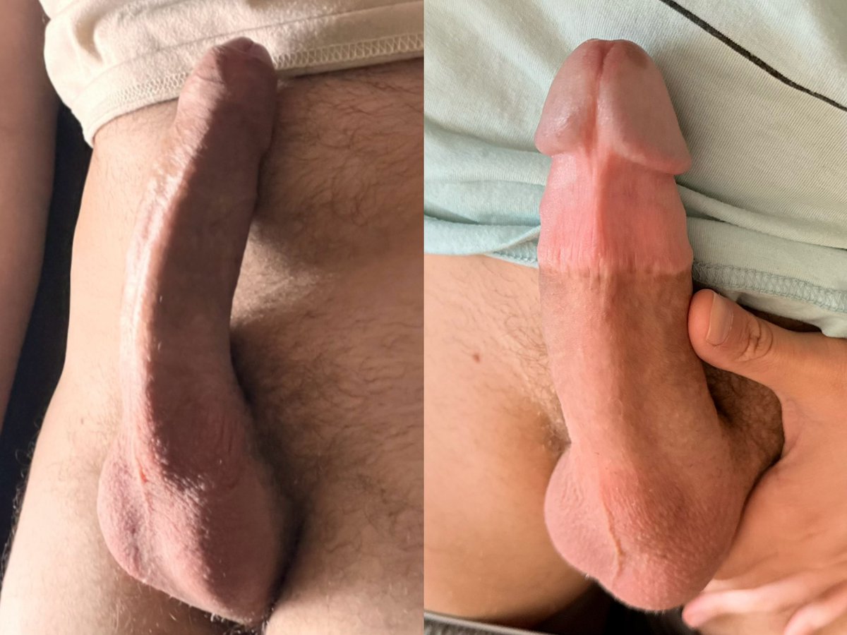 One new circumcision before and after for twitter, and a second one now exclusively available on Onlyfans.com/hugeshlong 😙