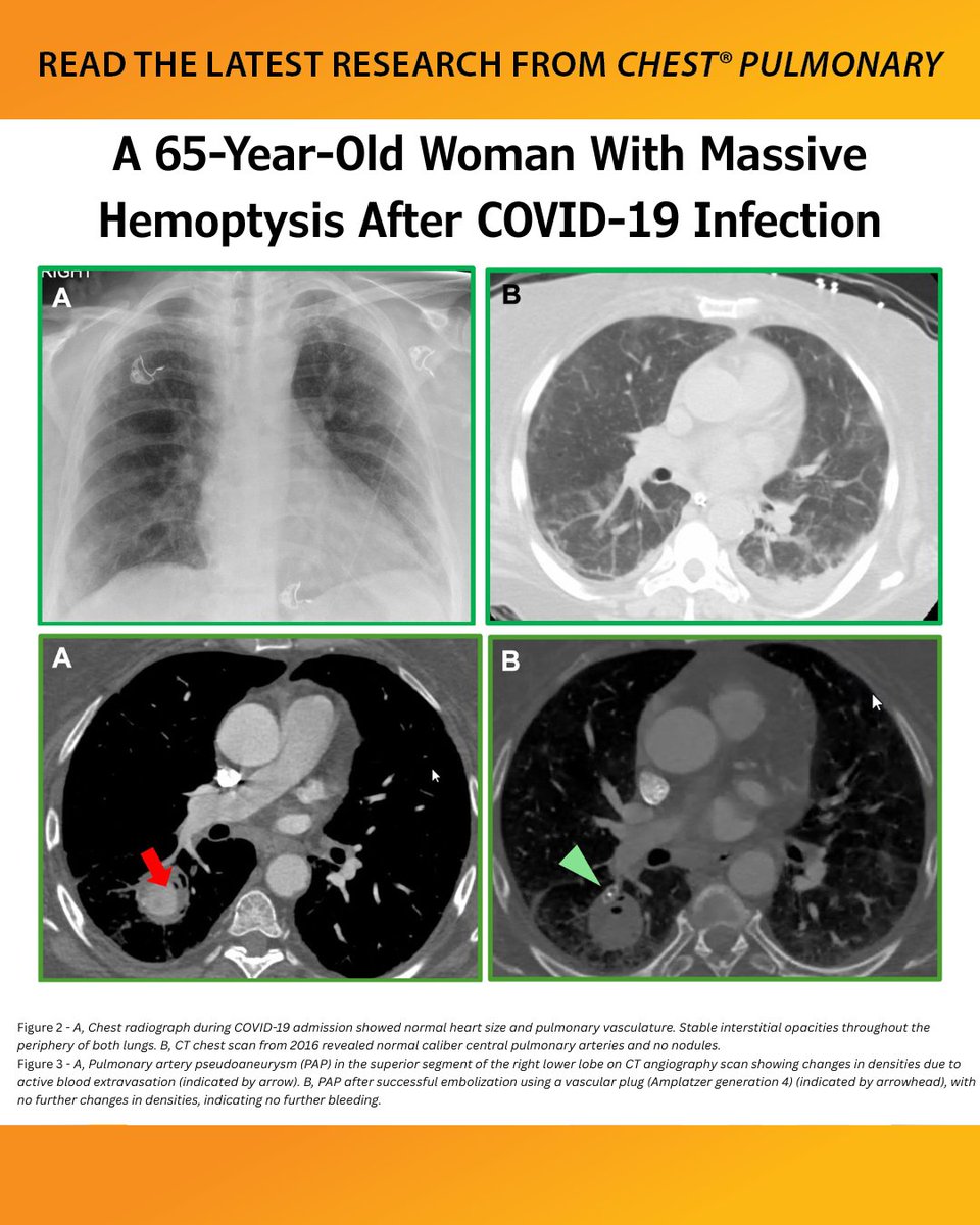 journal_CHEST's tweet image. A 65-Year-Old Woman With Massive Hemoptysis After COVID-19 Infection
Read more in the June issue of #journal_CHESTPulm: hubs.la/Q03y7R_X0
#MedEd #JournalCHEST