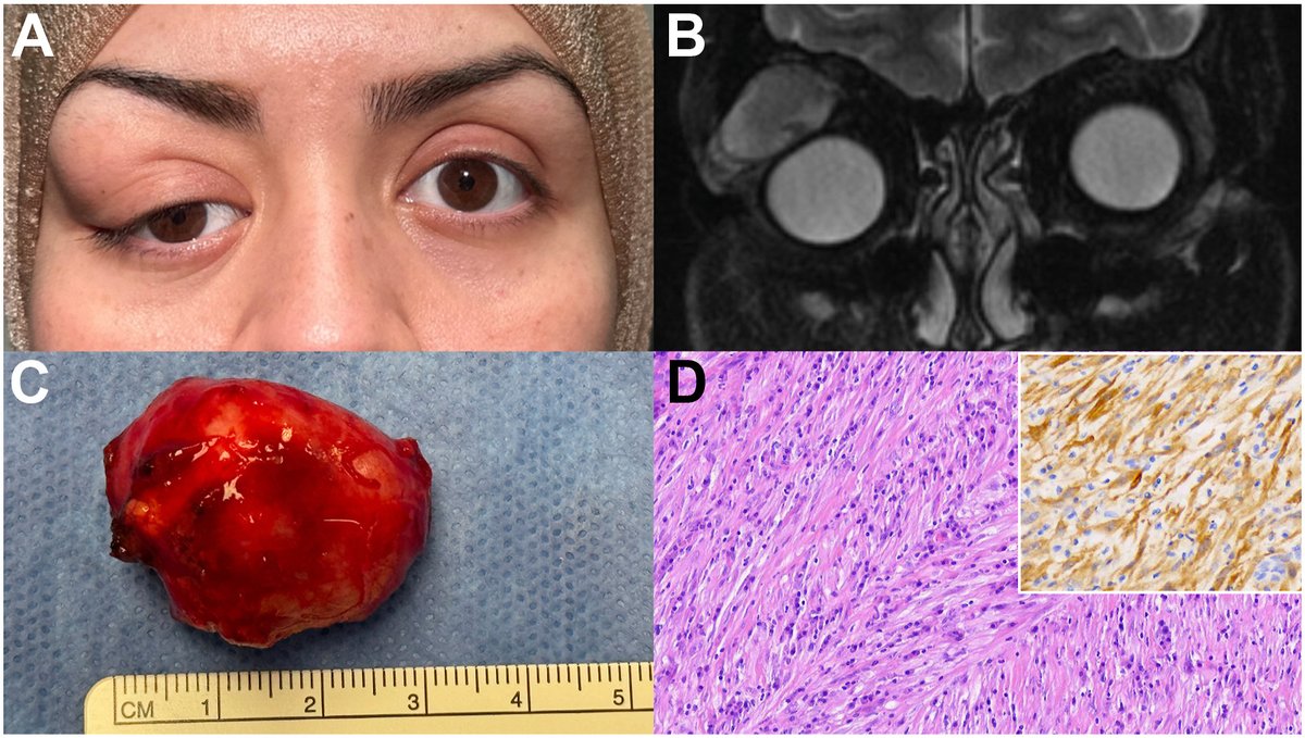 AAOjournal's tweet image. Orbital Inflammatory Myofibroblastic Tumor Presenting in a Pregnant Patient
ow.ly/KEpj50WcVBM
#ophthalmology