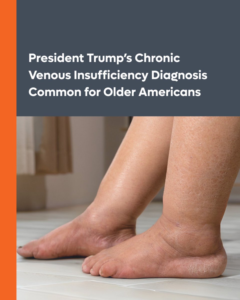 Ten percent to 35 percent of all adults in the U.S. live with chronic venous insufficiency (CVI), a blood flow condition making headlines after President Donald Trump's recent diagnosis.

More about CVI and how it's treated 👇🏽 

 bit.ly/450i4jV

#CVI