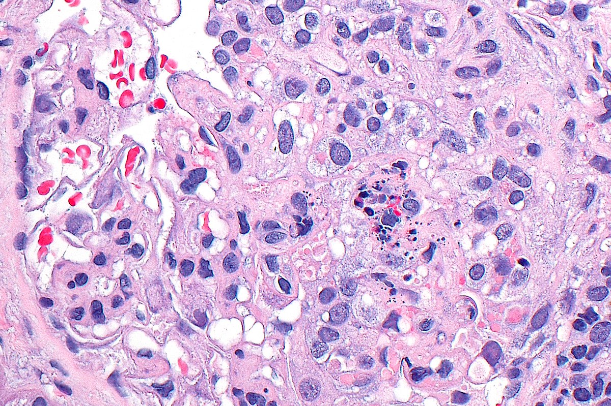 🔬📷 Glomerulus with karyorrhexis, hyaline thrombi, and a cellular crescent in patient with class III lupus nephritis ~ #RenalPath #Pathology #Kidney #Nephrology