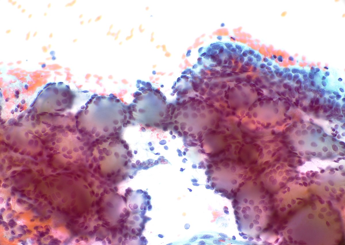 Textbook example of adenoid cystic carcinoma on #CytoPath. Remote history of submandibular gland resection.