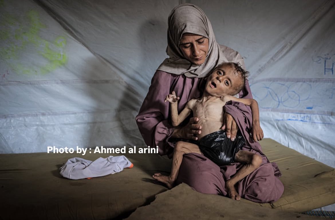 I_say_Toad's tweet image. What I’m about to say will drive many of the pro-Palestinian accounts into a frenzy, but needs to be said:
There are several genetic/congenital disorders which can mimic the symptoms of extreme malnutrition and starvation. Cystic Fibrosis, Spina Bifida and Cerebral Palsy are…