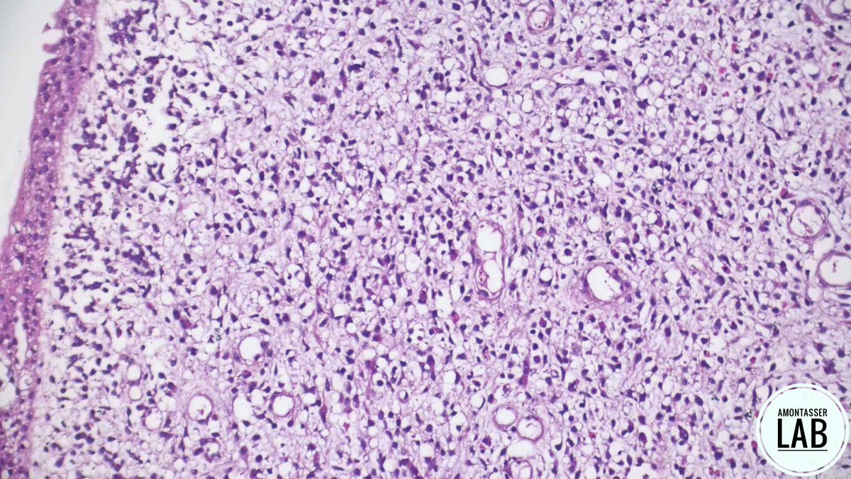 AMontasserMD's tweet image. 7 Y 👦🏻
Biopsies from a huge urinary bladder mass❗️
#GUpath #Pathology #PathX