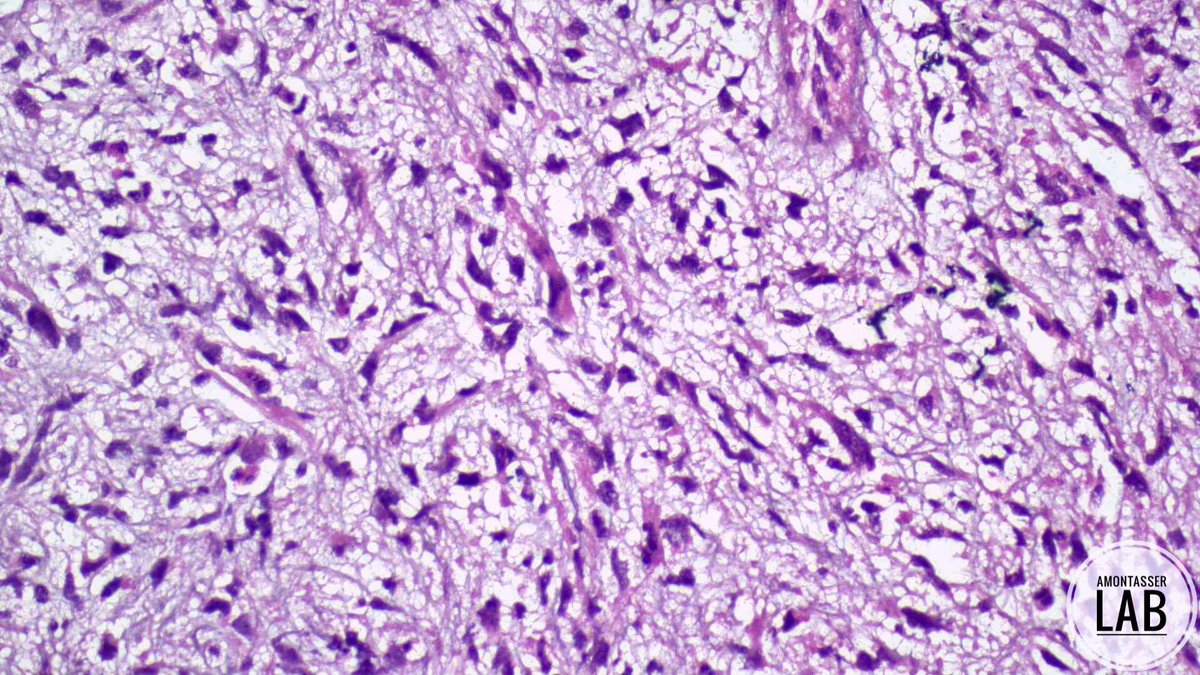 AMontasserMD's tweet image. 7 Y 👦🏻
Biopsies from a huge urinary bladder mass❗️
#GUpath #Pathology #PathX