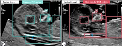 Radiology_AI's tweet photo. #AI-based model for real-time nuchal translucency plane identification and measurement in prenatal US assessments https://t.co/OIpwHD8axf @ShenzhenUni #prenatal #sonogram #ML https://t.co/FN3JLv5o11