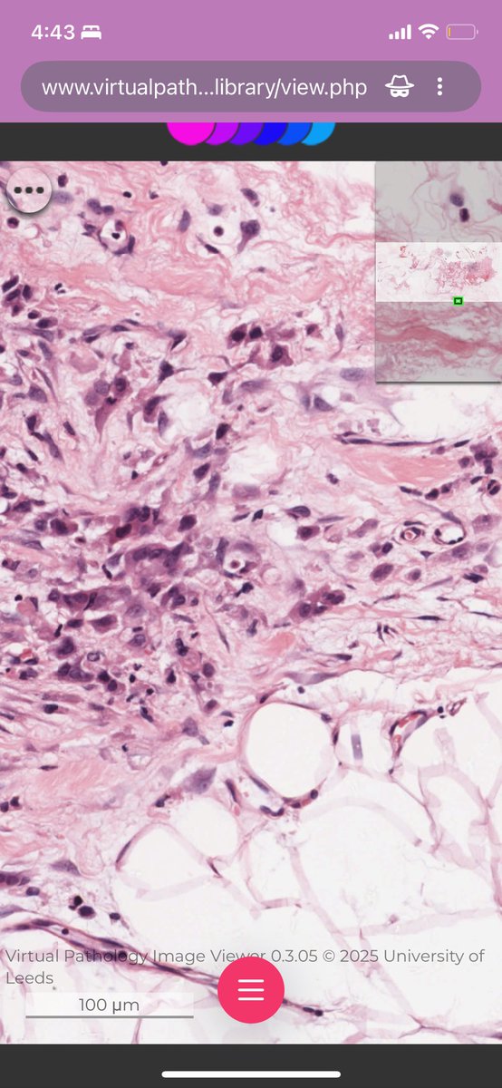 Juan Jose Sanchez Ramirez (@pathologybites) on Twitter photo <a href="/MaiElzieny/">Mai Elzieny</a> This is amazing. Thank you.
I recently made a WSI search engine specifically thought for residents studying for Boards!
It includes the sources you mentioned and a few more. :)
pathologybites.com/tools/virtual-… <a href="/MaiElzieny/">Mai Elzieny</a> This is amazing. Thank you.
I recently made a WSI search engine specifically thought for residents studying for Boards!
It includes the sources you mentioned and a few more. :)
pathologybites.com/tools/virtual-…